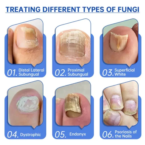 QIAWI™ PureNail Fungus Laser Device